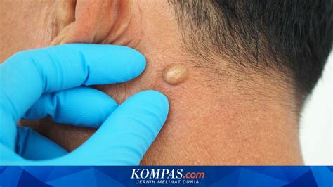gejala kista epidermoid  perlu diwaspadai
