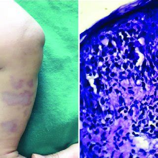 granuloma annulare     scaly skin color patches  raised