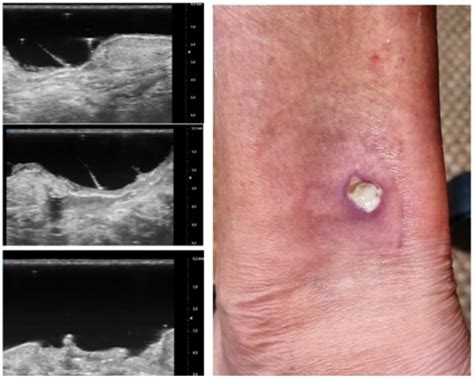 The Role of Ultra-High-Frequency Ultrasound in Pyoderma Gangrenosum