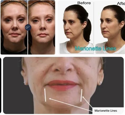 Marionette Lines Filler Gone Wrong, Information Guide