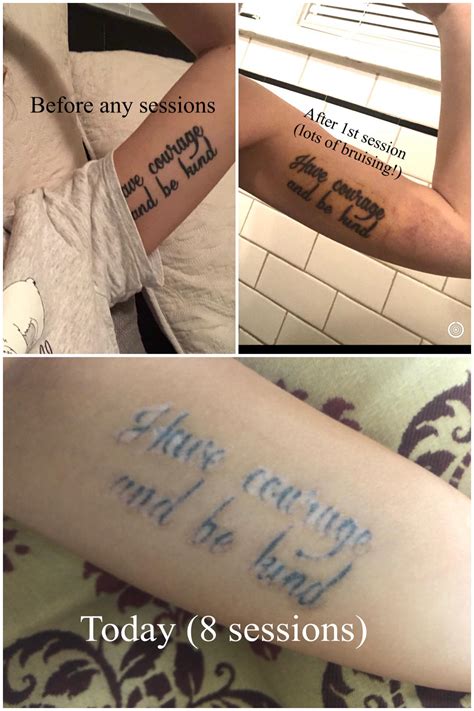My tattoo removal progress with PicoSure laser : r/TattooRemoval