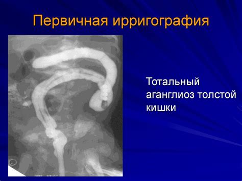 Врожденная кишечная непроходимость - презентация онлайн