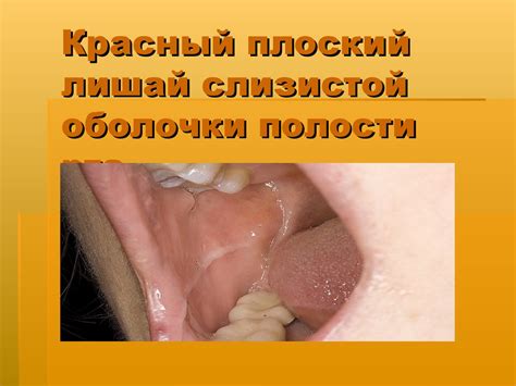 Красный плоский лишай слизистой оболочки полости рта - презентация онлайн