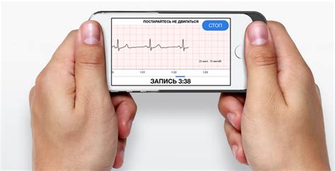 Кардиофлешка ecg dongle электрокардиограмма – Кардиофлешка ECG Dongle ...