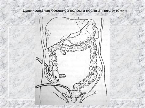 Острый аппендицит - презентация онлайн