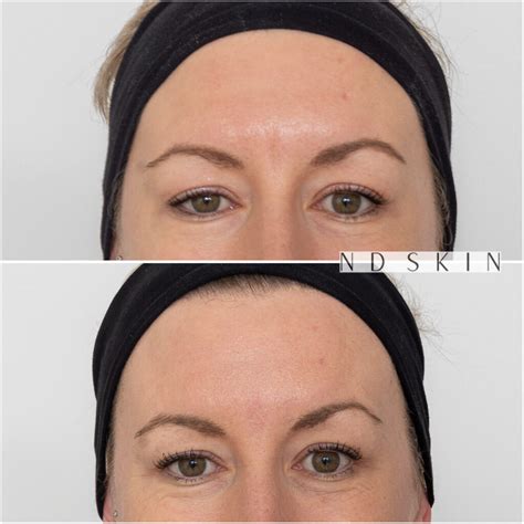 Glabellar Filler Gallery - ND Skin - Before and Afters