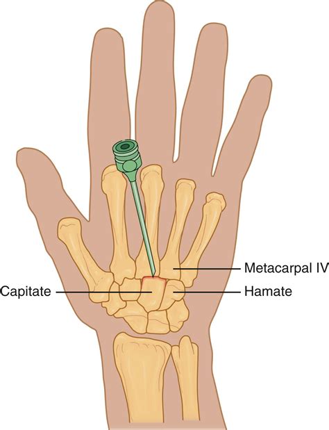 Carpometacarpal Joint