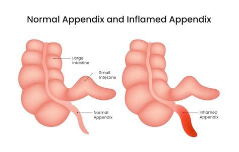 premium vector normal appendix  inflamed appendix