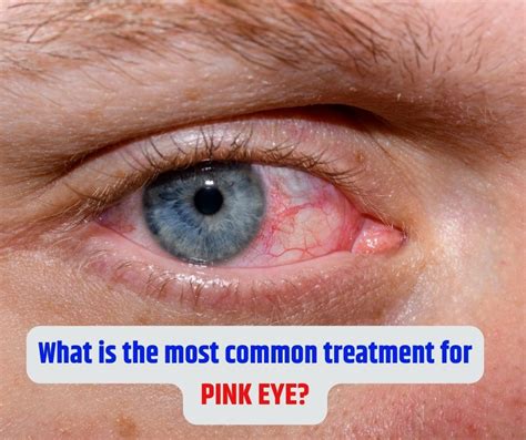 home care treatment  pink eye  carlos snyder blog