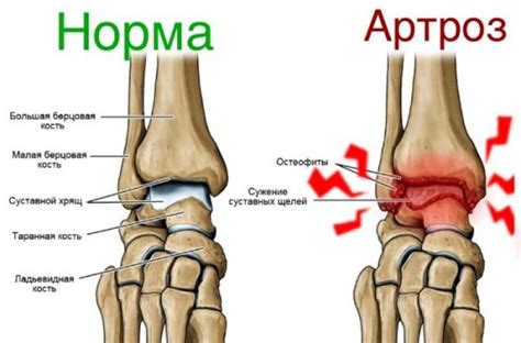Артроз голеностопного сустава - признаки, причины, симптомы, лечение и ...