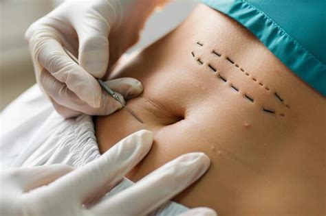 O Corpo Expulsa Pontos De Cirurgia - Cirurgião removendo pontos após operação do abdômen do paciente ...
