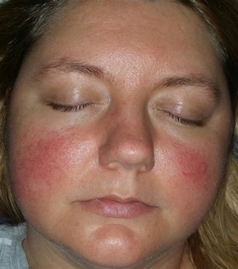 rosacea rosacea facial redness acneorg forum