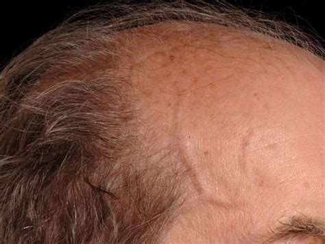 giant cell arteritis   giant cell arteritis