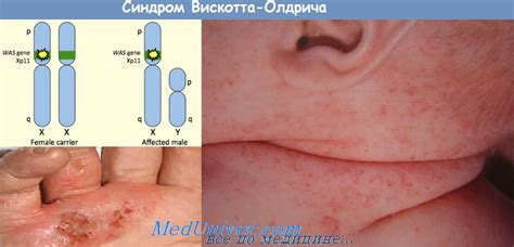 Синдром Вискотта-Олдрича (Wiskott-Aldrich) - синонимы, авторы, клиника