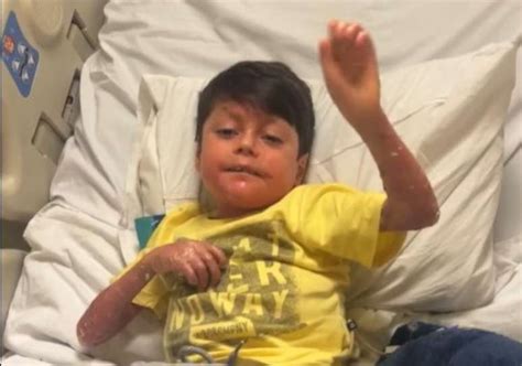 Epidermolysis bullosa: Understanding the condition causing 'butterfly ...