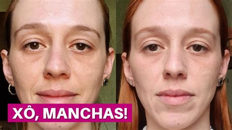 Creme Antissinais Antes E Depois - Creme De Acido Kojico Antes E Depois Ácido Kójico Vitamina C