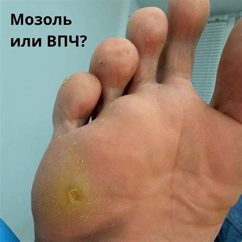 Как отличить обычную мозоль от подошвенной бородавки (ВПЧ)? | Leo ...