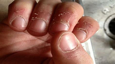 7 أمراض خطيرة تعرفها من شكل الأظافر - سبعات