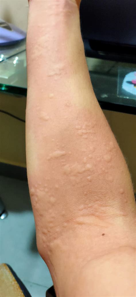 117 best r/urticaria images on Pholder | I cant anymore