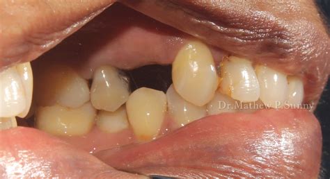 implant placement basic surgical protocol myzerodonto