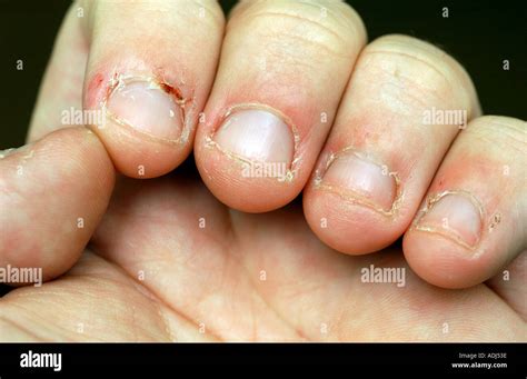 Nail biting nailbiting strain worried biting bitten horizontal hi-res ...