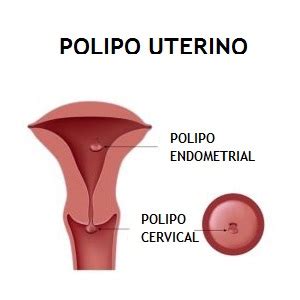 O Que É Pólipo No Útero - PÓLIPO UTERINO - Dr. Eduardo Dale - Ginecologia e Reprodução Humana