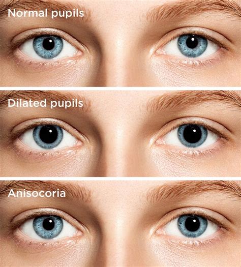 O Que Significa Pupila Dilatada - Pupilas dilatadas: Causas, preocupaciones y tratamiento | Todo sobre la ...