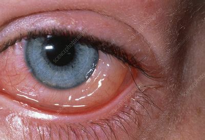 Eye: allergic conjunctivitis & conjunctival oedema - Stock Image - M155 ...