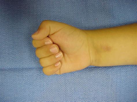 birth simple incomplete syndactyly release