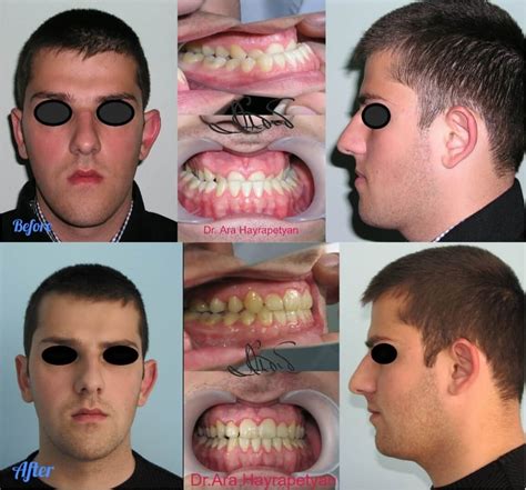 Пластика челюстей фотогалерея | Dr. Ara Hayrapetyan