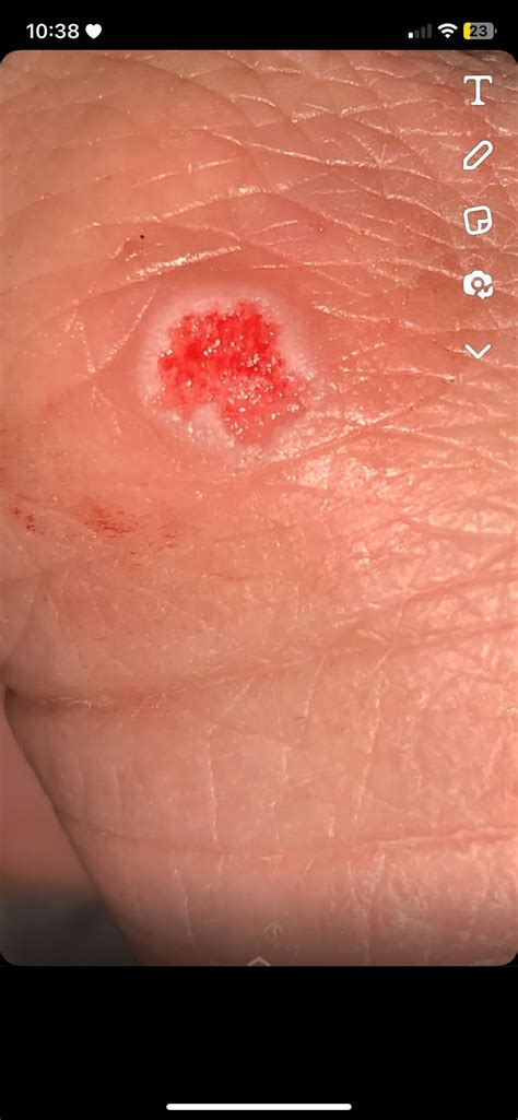 how to know if a wart is dead