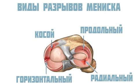 Мениск коленного сустава