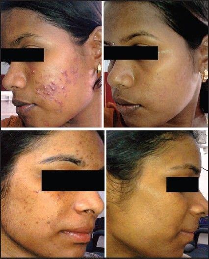 Before and after photographs of patients in isotretinoin + salicylic ...