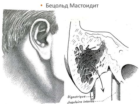 Мастоидит, түрлері, клиникасы, диагностикасы, емі - презентация онлайн