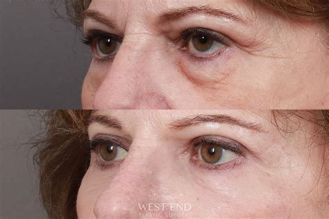 Lower & Upper Blepharoplasty Before & After Gallery - Case: 10185