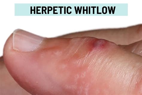 itchy bumps filled  clear liquid  itchy blister rashes