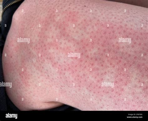 mottled skin heat rash hives allergy reaction on knee close-up ...