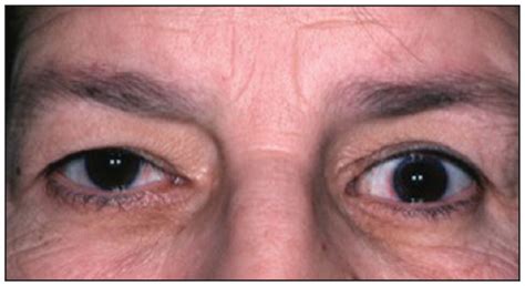 Periorbital Edema Hypothyroidism