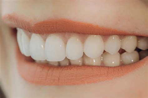 Types of Veneers | East Valley Dental Professionals