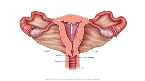 Iud Diagram Uterus