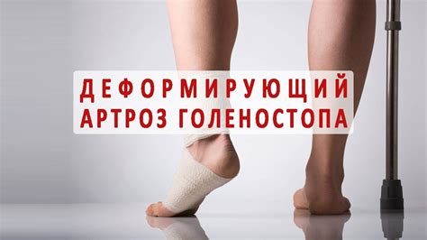Что нужно знать о деформирующем артрозе голеностопного сустава - YouTube