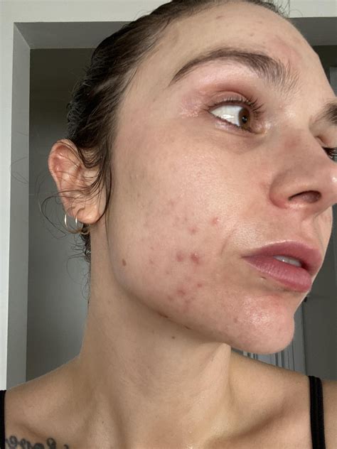 Painful lumps the last few months - thinking Cerave moisturiser could