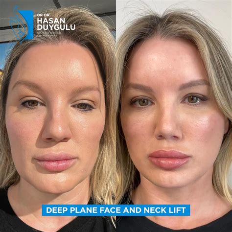 scarless facelift  turkey istanbul dr hasan duygulu