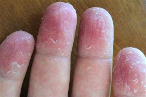 Причины шелушения кожи на пальцах рук. Лечение кожи на руках