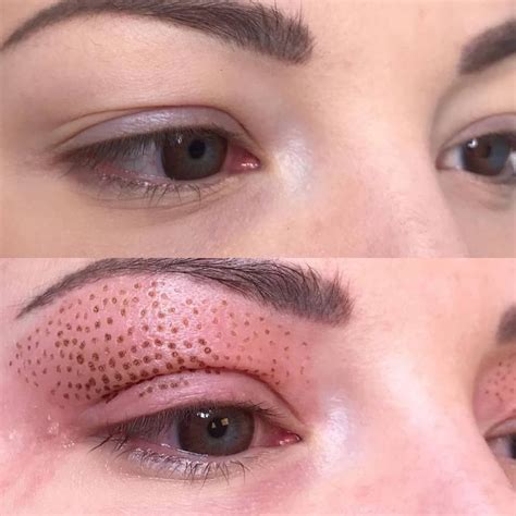 Jato De Plasma Nas Palpebras Antes E Depois