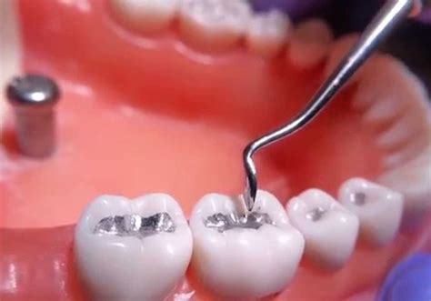 amalgam fillings  smiles clinic
