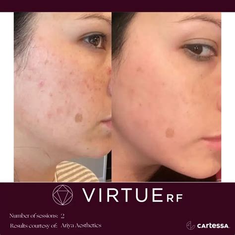 Virtue RF Microneedling - Only the Best at #1 Swisher Skin and Laser Center