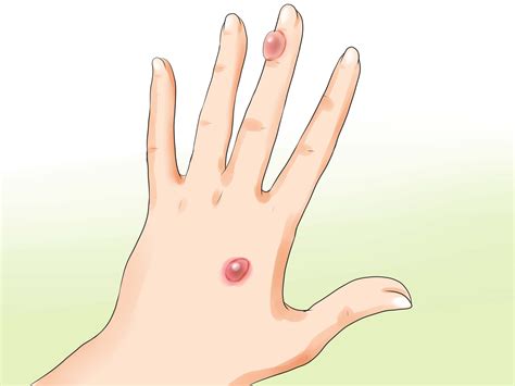 Burn Blisters How To Treat