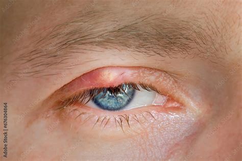 chalazion slow growing lump  cyst  develops   eyelid