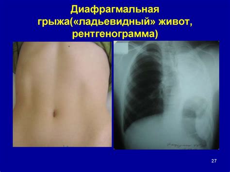 Диафрагмальные грыжи у детей - презентация онлайн